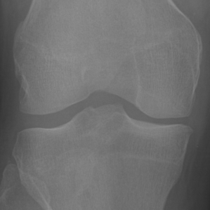 Original knee X-ray